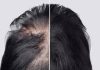 Losing hair because of Alopecia? This Arthritis drug can help you regrow hair like never before |