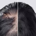 Losing hair because of Alopecia? This Arthritis drug can help you regrow hair like never before |