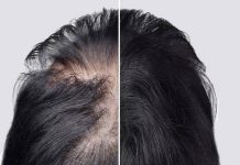 Losing hair because of Alopecia? This Arthritis drug can help you regrow hair like never before |